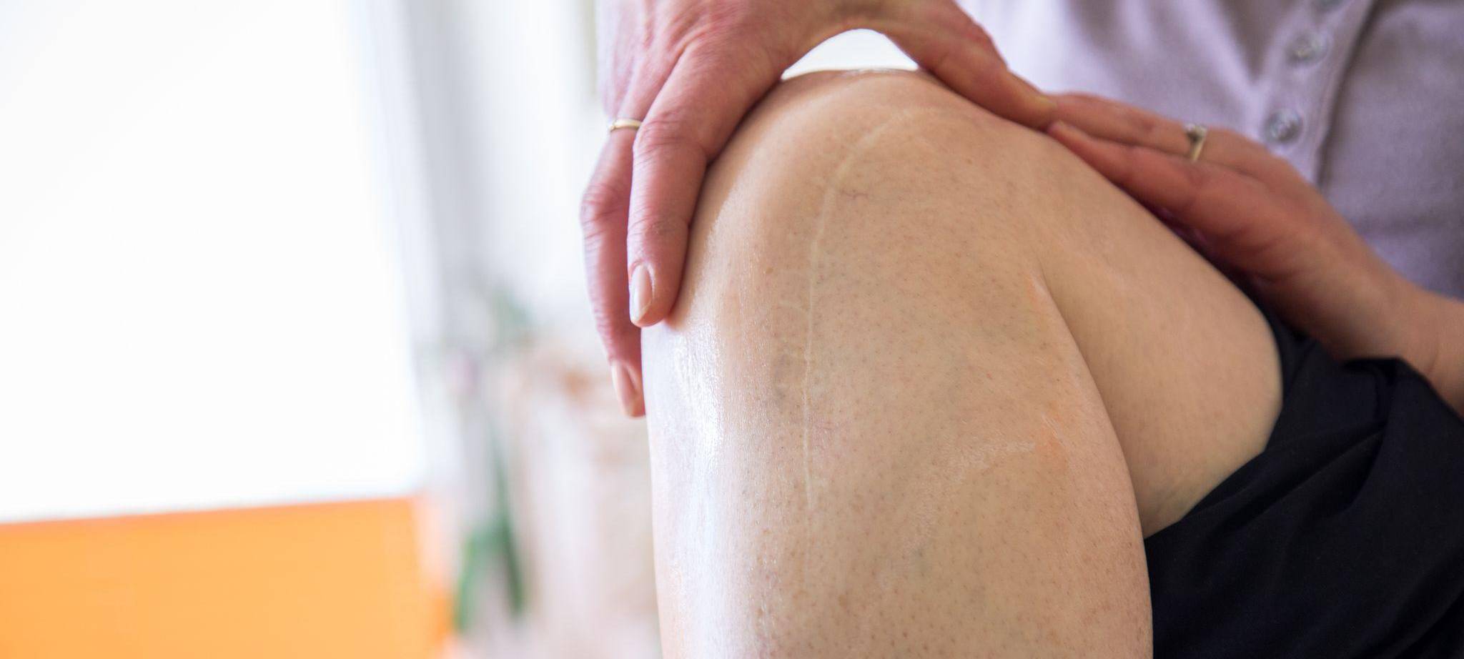 Eine Frau massiert eine Operationsnarbe am Knie
